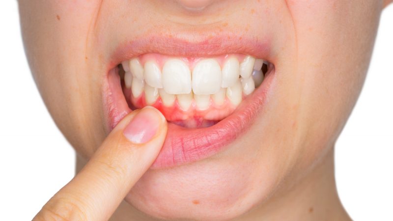 Cut on Gums – How to Treat and Prevent It?